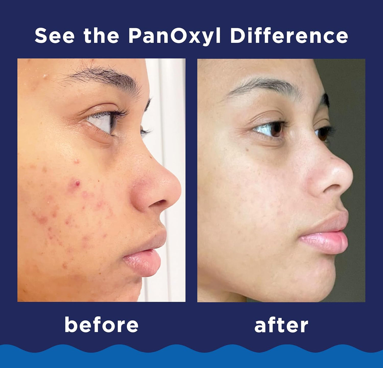 PanOxyl Acne Foaming Wash 156g