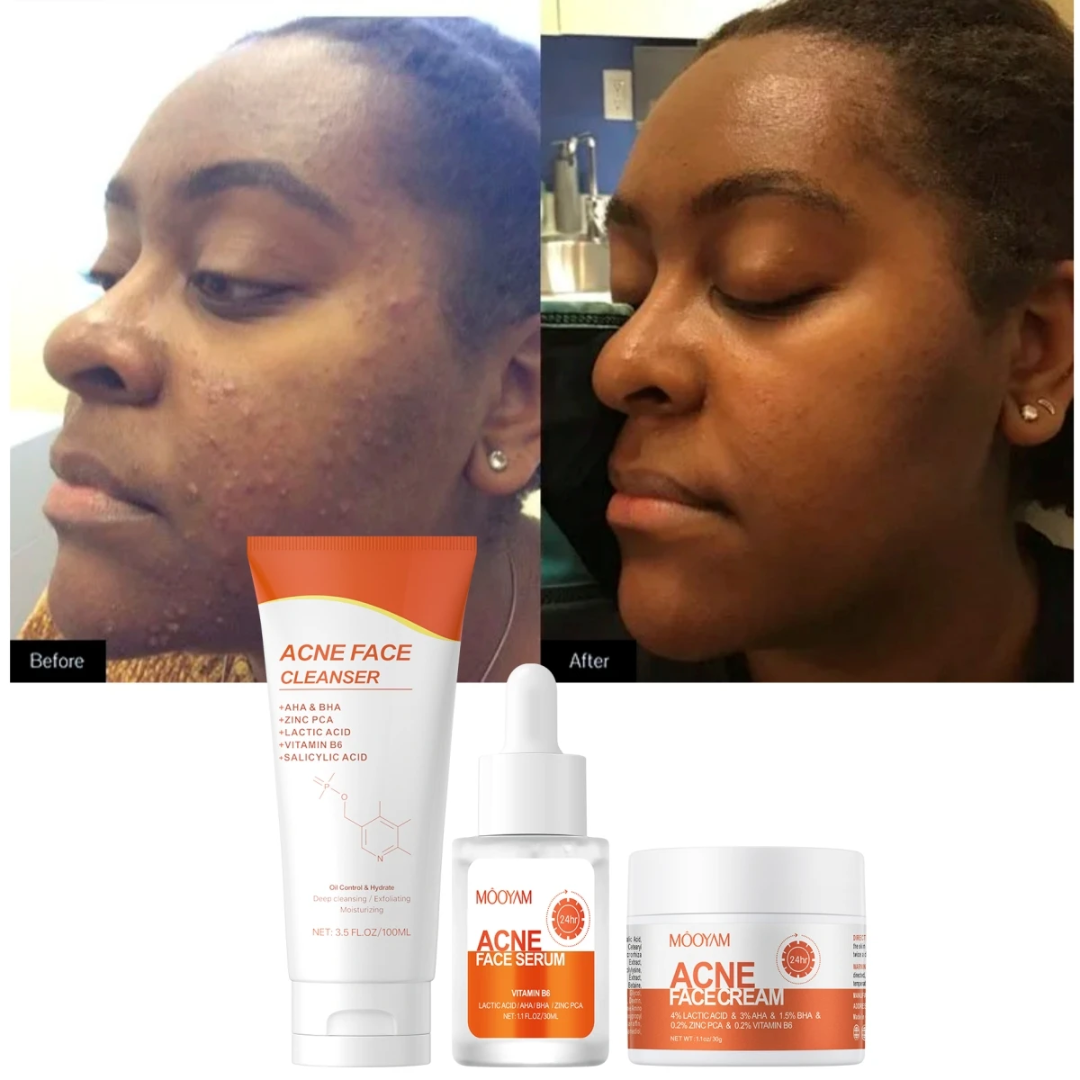 MOOYAM ACNE SET
